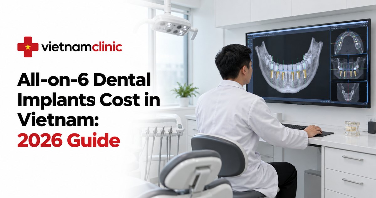 All-on-6 Dental Implants Cost in Vietnam: 2026 Guide